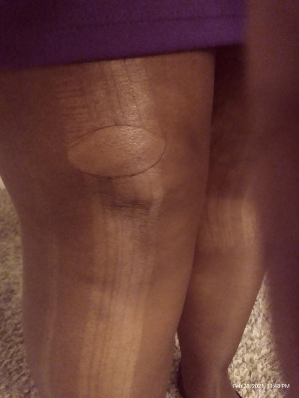 The end result from the tiny hole from my ring.