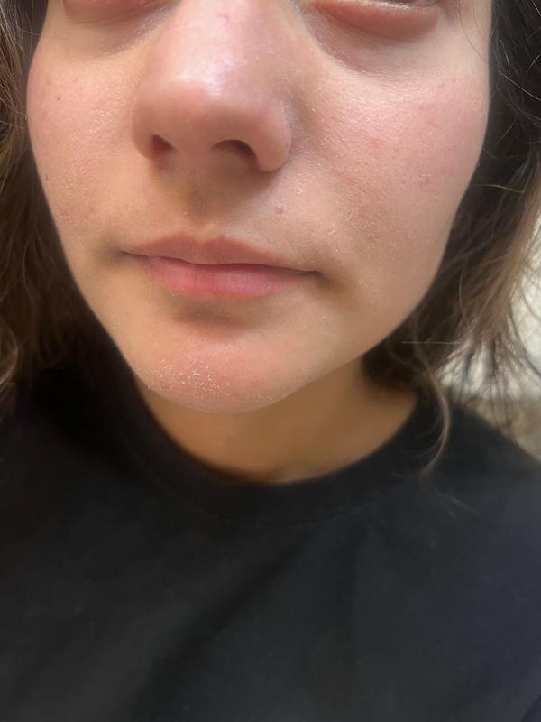 Customer photo for "Devestated: ruined my skin and dried it out"