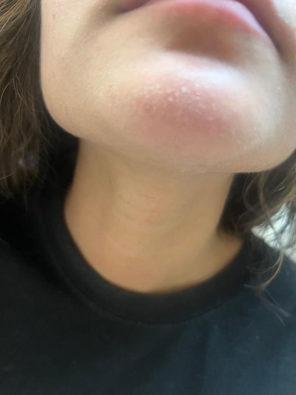 Customer photo for "Devestated: ruined my skin and dried it out"