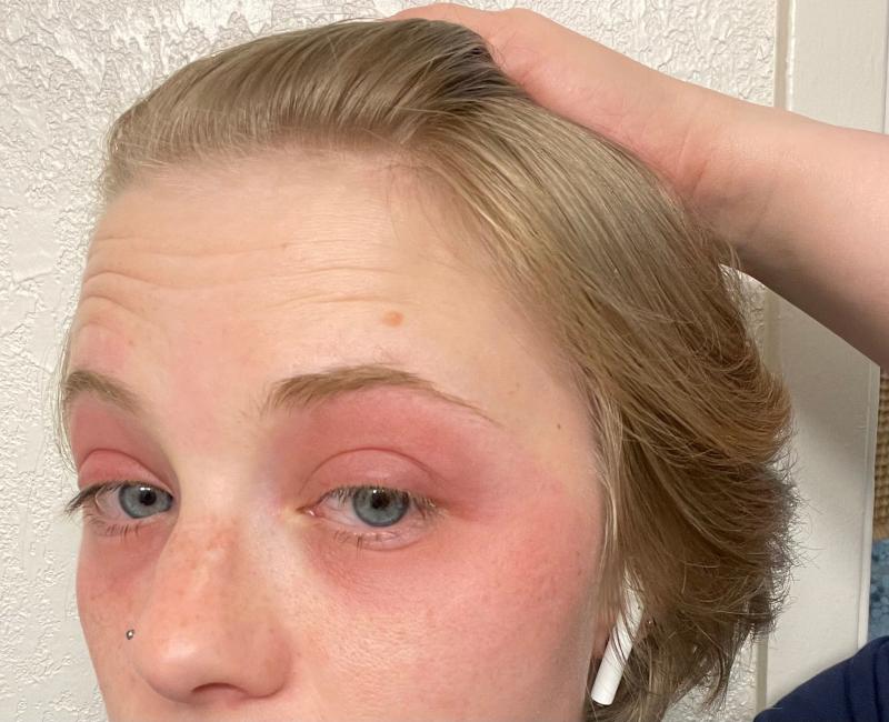 Customer photo for "Horrible chemical burn"