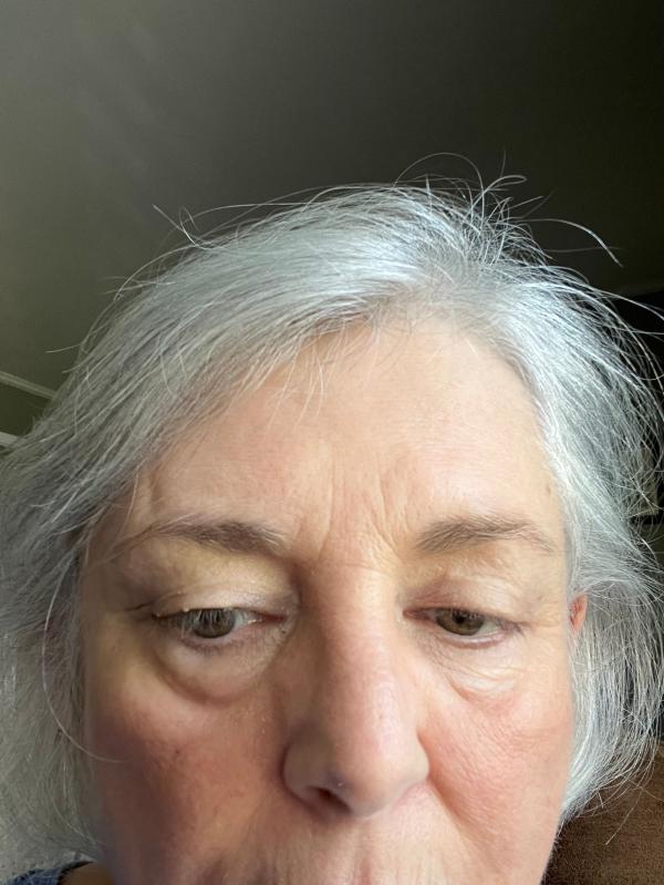 Customer photo for "Non Invasive Eye lift"