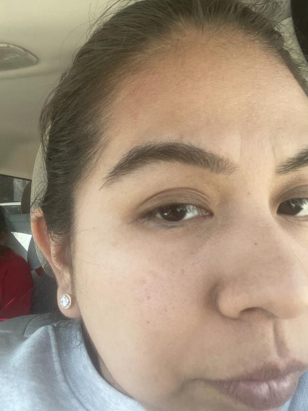 Had a little redness