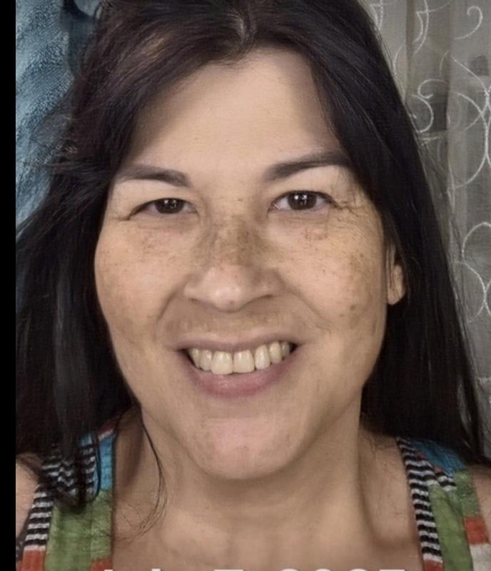 Before Your Skin But Better! (as you see, I have very prominent melasma)