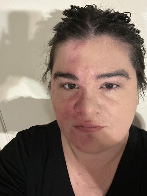 Half my face done. Great coverage (covers rosacea)