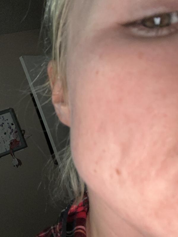 My burning, red cheek