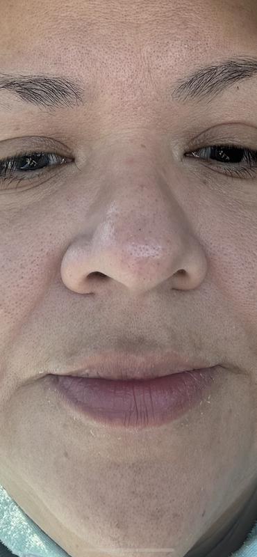 Before I started using Beso lip balm. Very dry lips