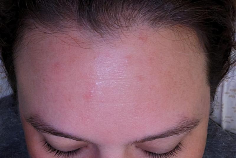 Rash on my forehead.
