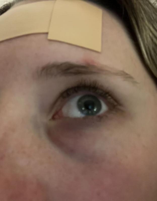 Customer photo for "My dark circles are vanishing after over a month!"