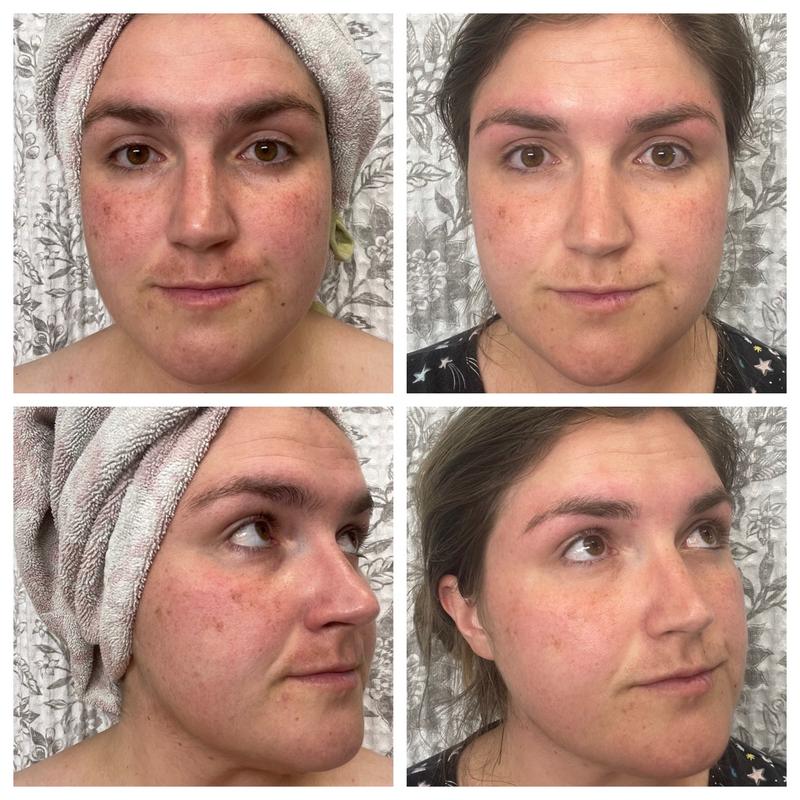 Customer photo for "Amazing for my redness and dark spots - big confidence boost!"