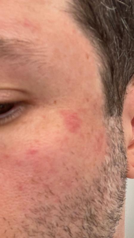 Customer photo for "Created Red Blotches"