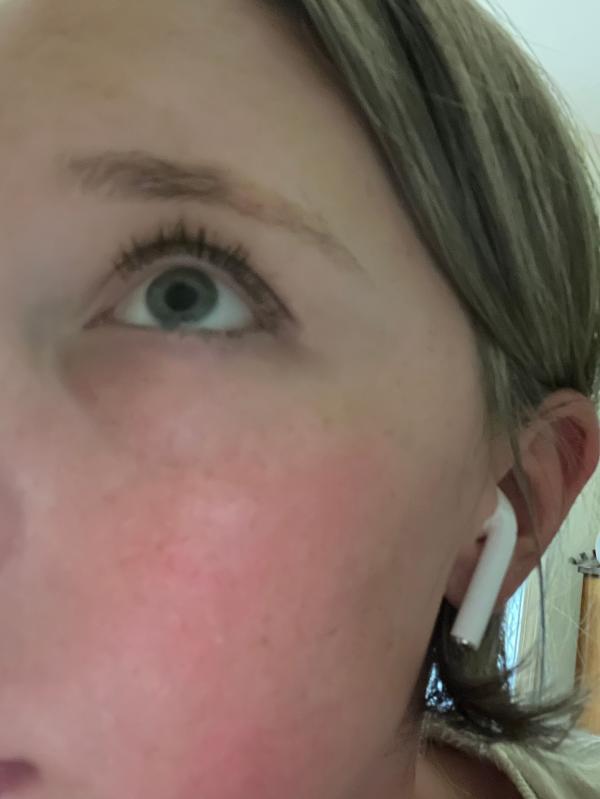 Customer photo for "My dark circles are vanishing after over a month!"