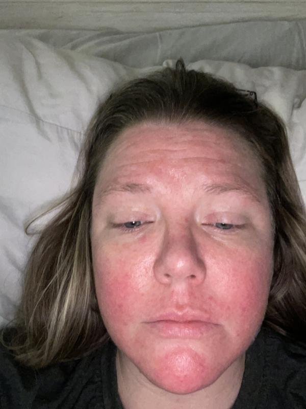 Customer photo for "My skin is dry and flaky"