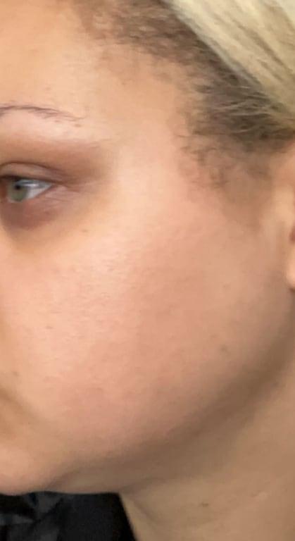 My skin today using origins for 3 months