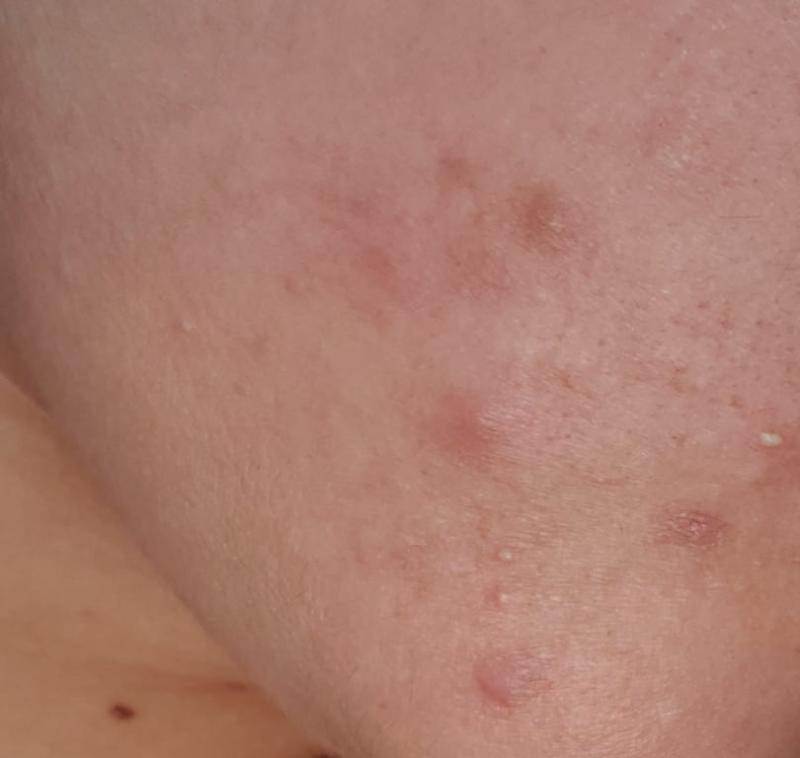 Cyst acne under skin