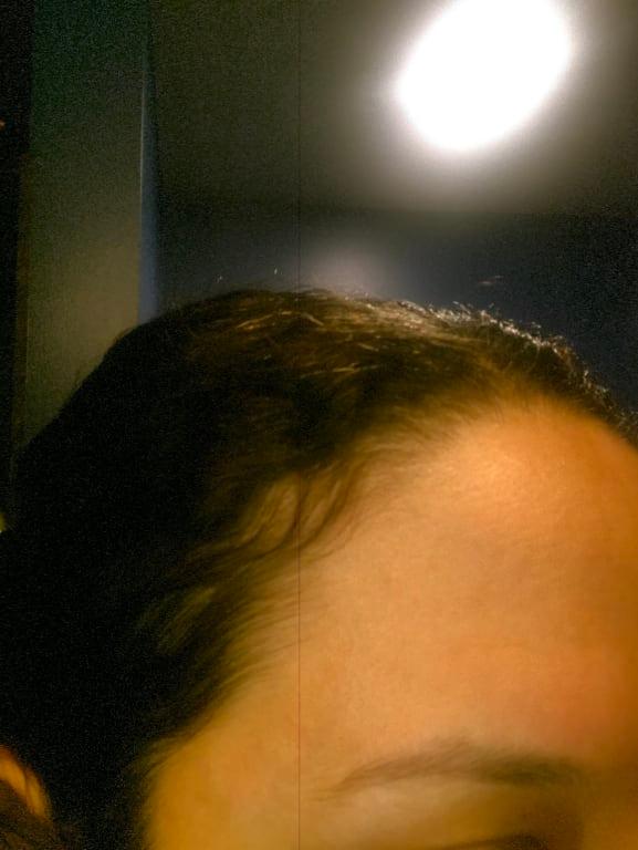 Itchy and burning forehead rash