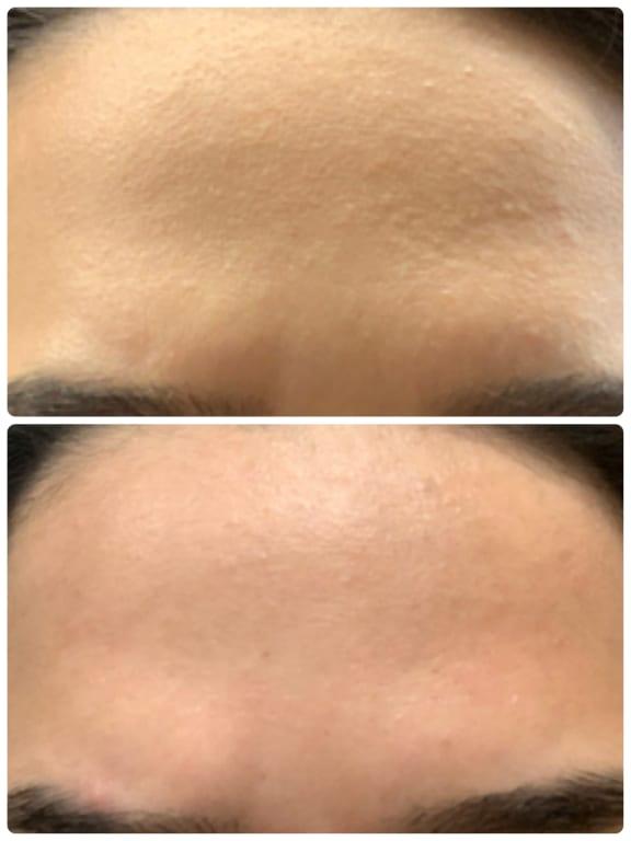 Before(top)/After(bottom)