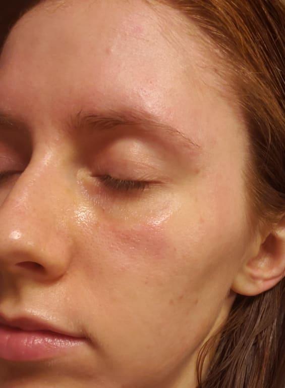 Using CeraVe night lotion to hopefully hydrate and calm my skin as it recovers