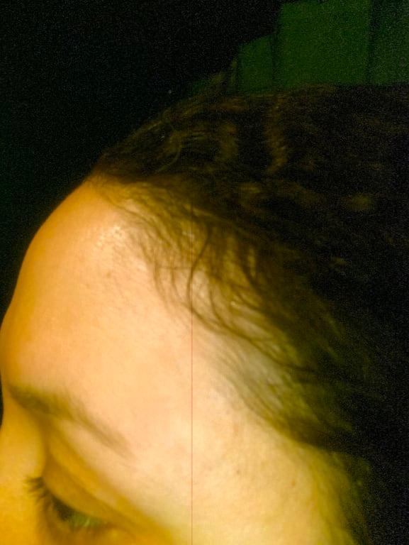 Itchy and burning Forehead rash :(