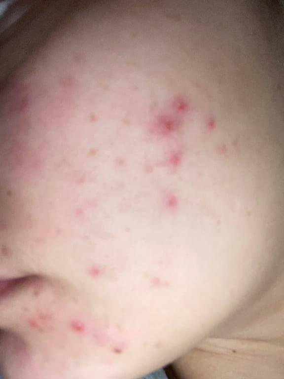 Customer photo for "Made me breakout - worst breakout I've had in years :("