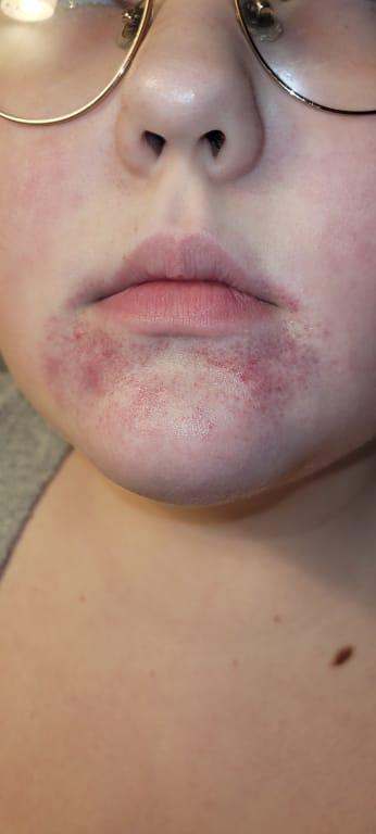 Customer photo for "I like it, but not my daughter (allergic reaction)"
