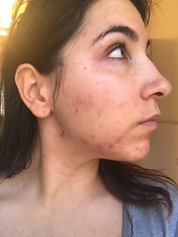 BEFORE - NO ONE WOULD SEE THIS BC I'D COVER UP WITH MAKEUP