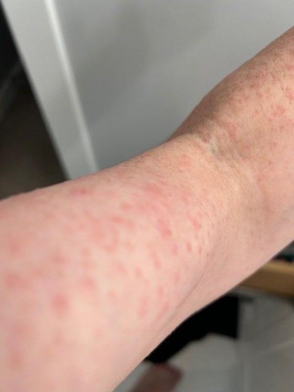 Customer photo for "Major allergic reaction"