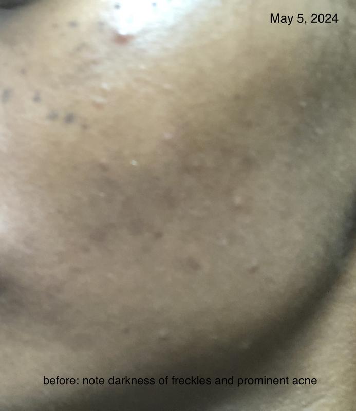 Before: note how dark my freckles are, and the prominence of my acne.