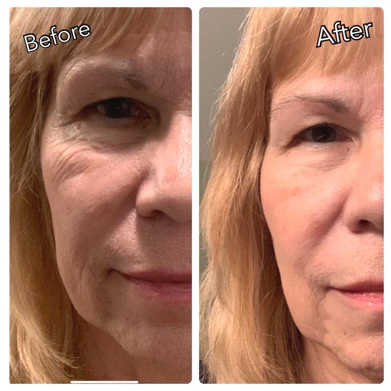 revitalift before and after