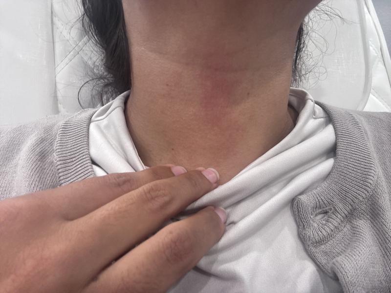 Rash