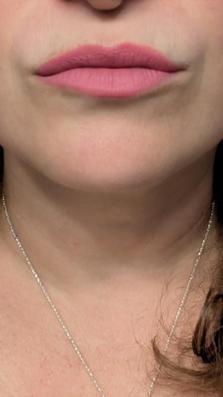 1 cost of Proposal on light-warm/neutral skin tone