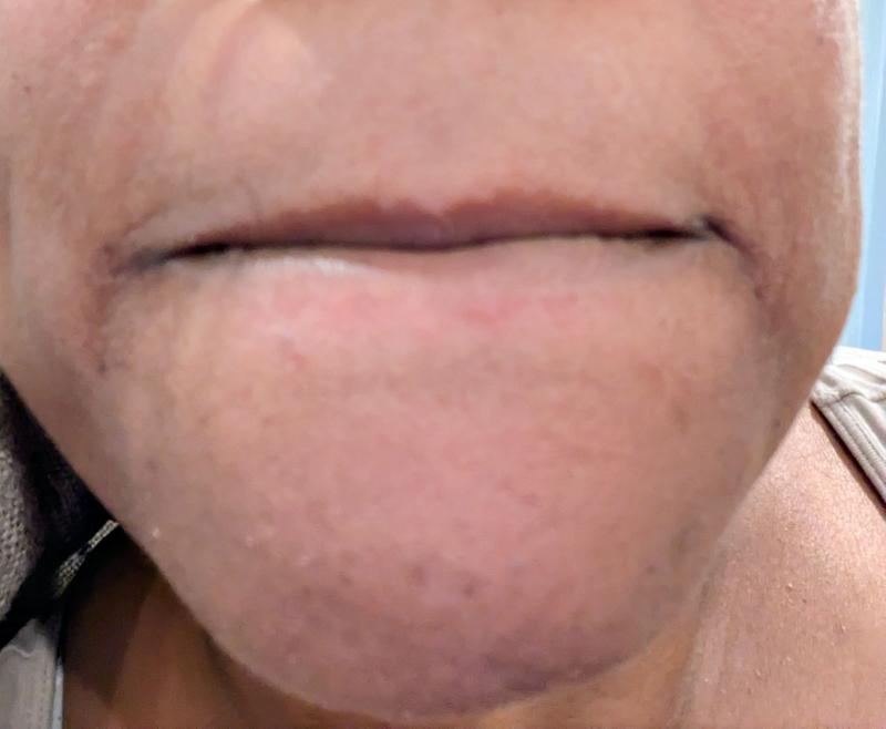 My chin nose and lip areas