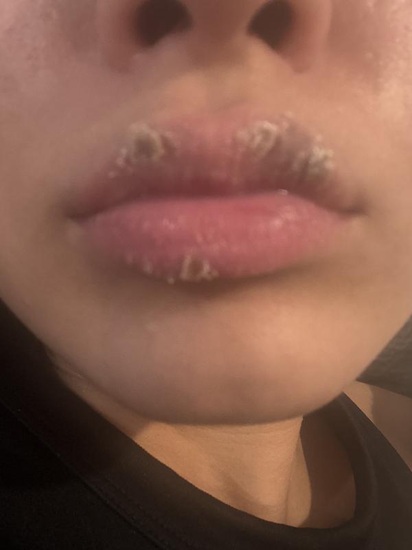 Terrible allergic reaction…