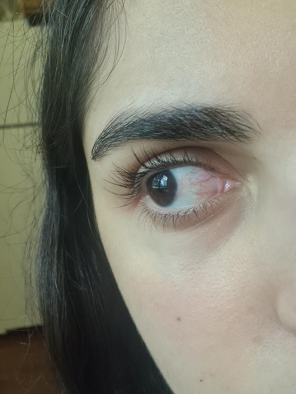 This redness has been there for 2 weeks and doesn't seem to be going away