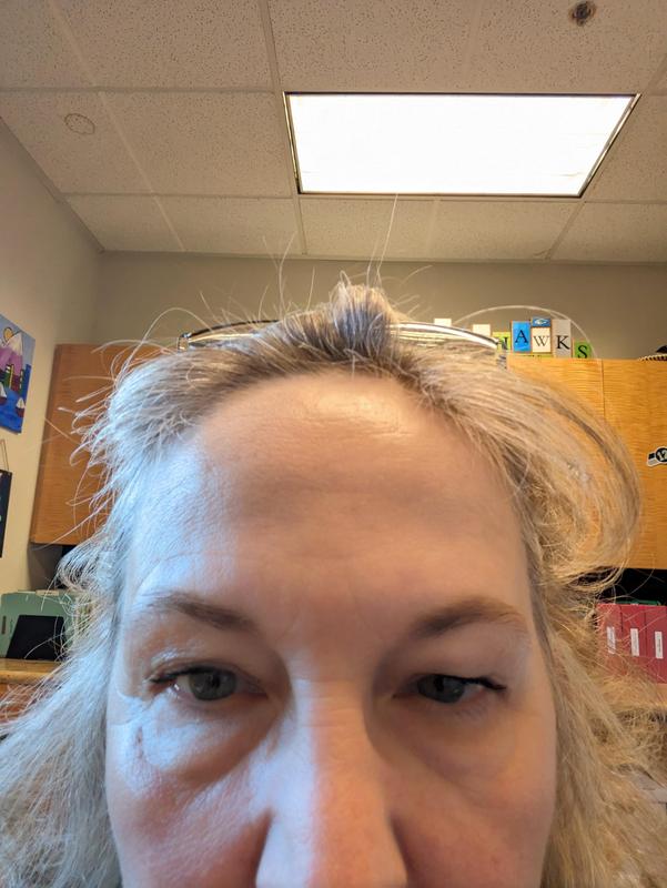 upper eye lids swollen