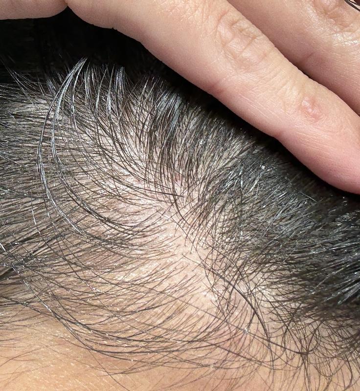 Currently have a hair mask in, but my scalp is so irritated
