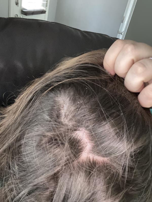 Some of the red and peeling even after a few days
