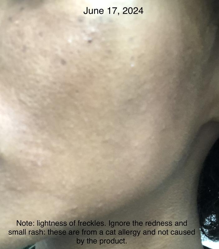 After: note how light my freckles became. Please ignore the redness and rash, they are from a cat allergy, and not related to the product.