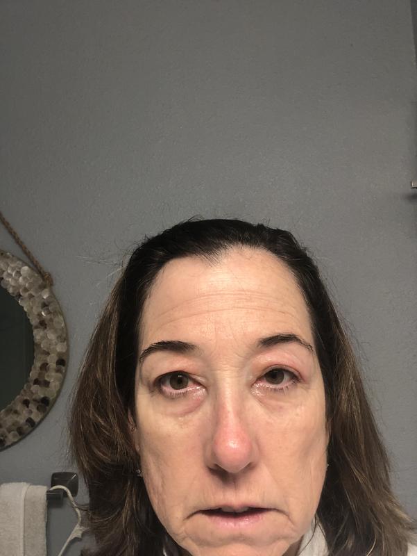 Swollen eyes