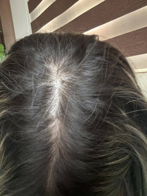 Hair growth