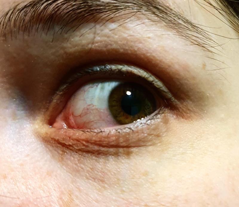 What my eye looked like after some of the product got in it