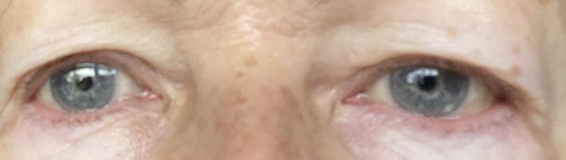 After treatment