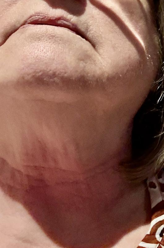 My neck after 3 days of suffering!
