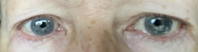 Before treatment