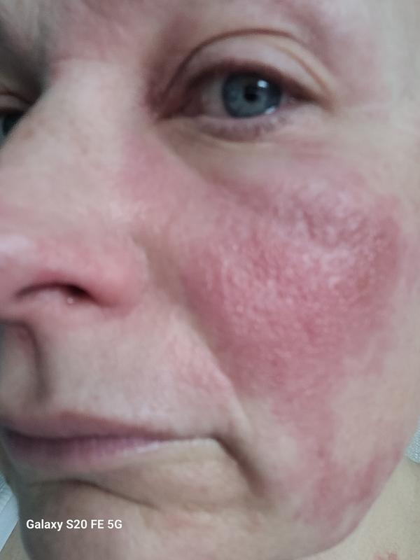Infection and burn injury due to using this product
