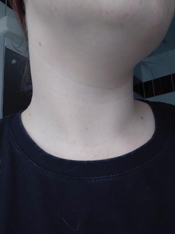 Significantly more obvious in real life, and the pic was before it had oxidised