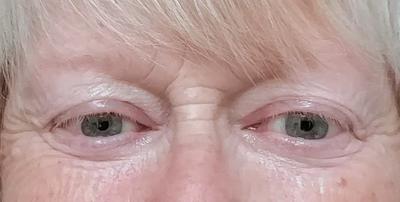 After using Age Perfect Eye Cream for a week.