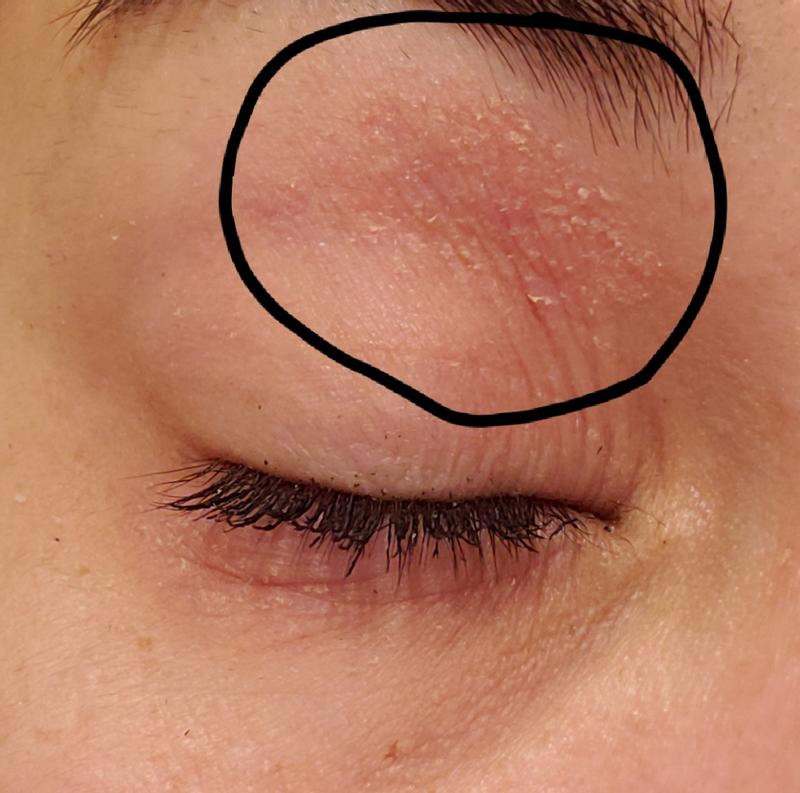 This is a week after using the product, my eyes are still healing. Imagine what it was like at the beginning.