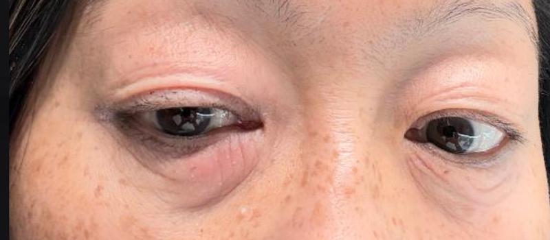 Photo 1: 1st application; Photo 2: 2nd application 3-4 days after recovering from the 1st application