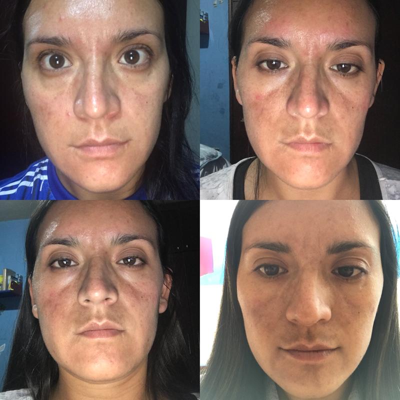 From a face with small spots to completely stained face