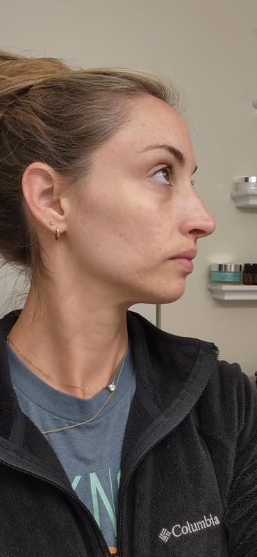 Taken 2 days ago, a month after adding Clarifique serum, and 3 weeks after adding the Clarifique essence